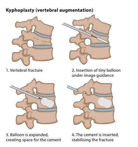 Kyphoplasty Education Physical Therapy Medical