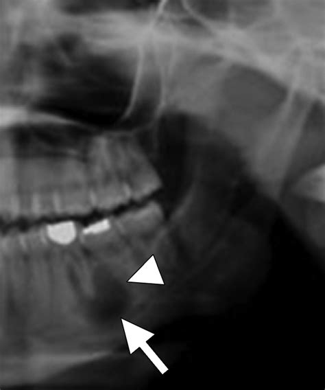 Median Mandibular Cyst