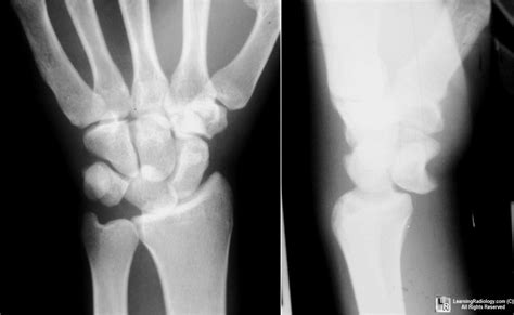 Learningradiology Carpal Instabilities