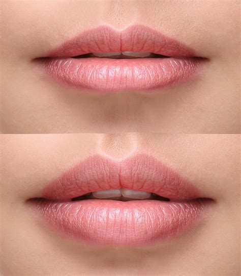 Best Natural Lip Fillers Lip Injections And Lip
