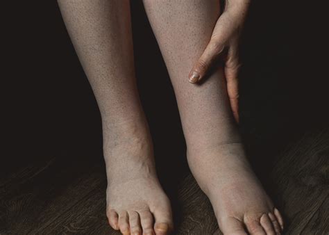The Importance Of Seeking Treatment For Lymphedema The Vein Institute
