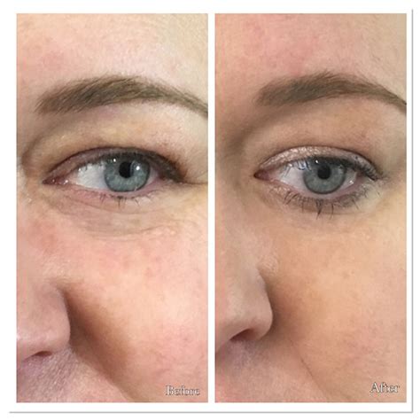 Pdo Thread Lift Before And After Photos Parfaire Medical Aesthetics