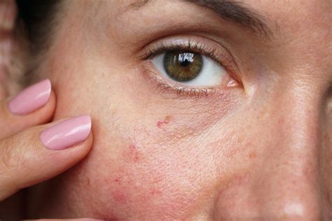 Broken Facial Capillaries Causes And How To Treat Them Your Laser Skin Care