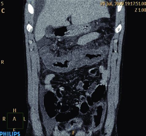 Coronal Cut Of Ct Scan With Intravenous Contrast Note The Marked