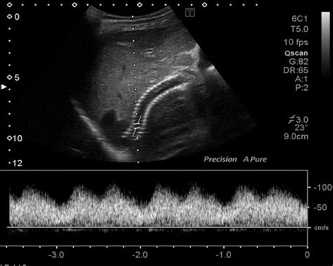 Transjugular Intrahepatic Portosystemic Shunt Ultrasound Evaluation