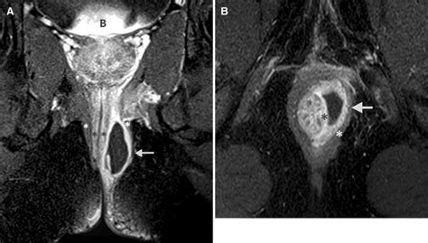 Mri Of Anal Canal Normal Anatomy Imaging Protocol And Perianal