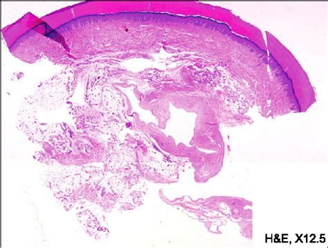 Figure 1 From Late Onset Eccrine Angiomatous Hamartoma Associated With