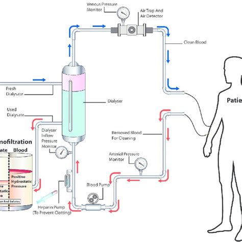 Principle Of Hemodiafiltration Download Scientific Diagram