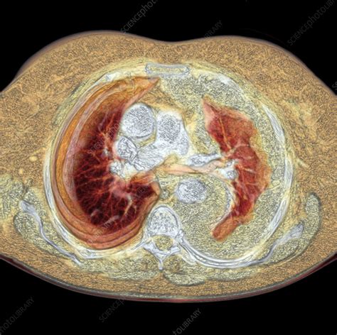 Lung Cancer Ct Scan Stock Image M Science Photo Library