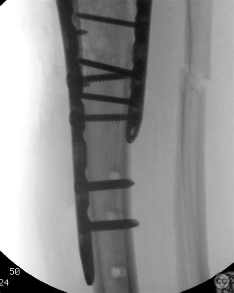 Combined Tibial Metaphysis And Plateau Fracture
