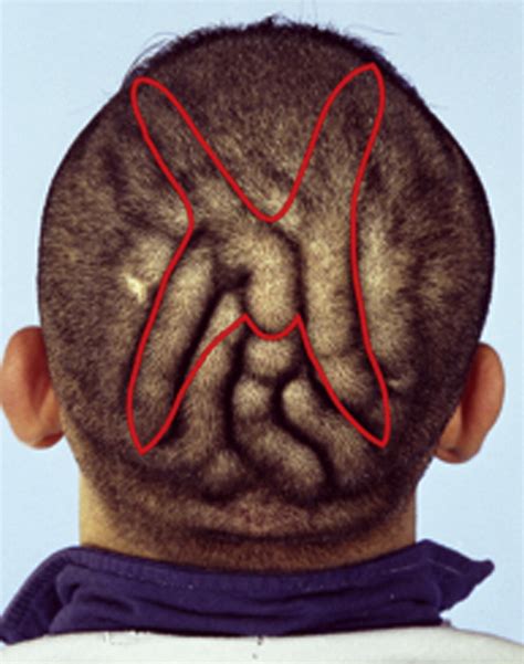 Butterfly Shape Scalp Excision A Single Stage Surgical Technique For