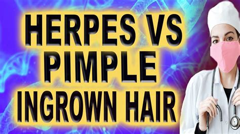Herpes Vs Pimple Ingrown Hair Youtube