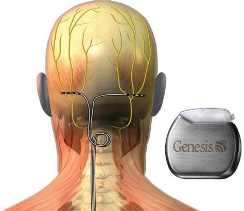 Occipital Nerve Stimulation For Migraine Occipital Neuralgia