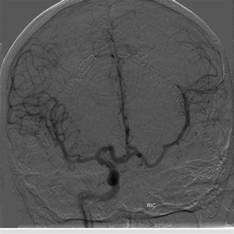 Pa Angiogram Of The Anterior Circulation Opacification Of The Bilateral