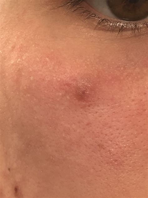 Itchy Bumps On Private Area