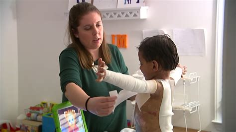Epidermolysis Bullosa Rare Skin Disorder Makes Chapel Hill 4 Year Old