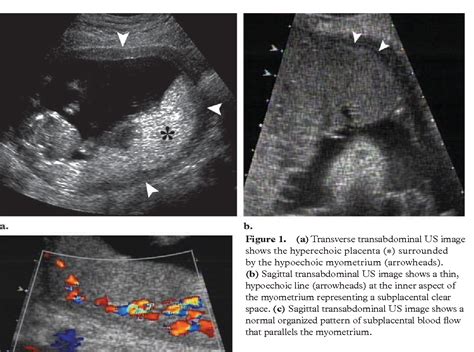 Pdf Placenta Accreta Spectrum Of Us And Mr Imaging Findings