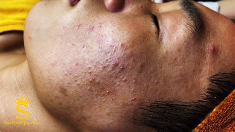 Acne Hidden Deep Under The Skin Mụn Ẩn Sâu Dưới Da Sacdepspa115