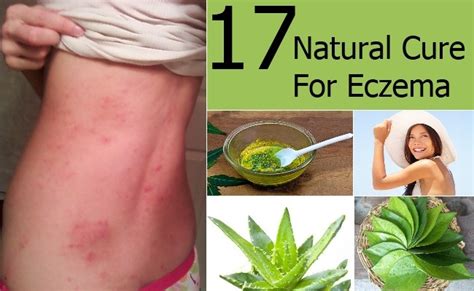 I was not sure what method to use but i didn't want to make my boy go through any surgery treatments at this young age. Natural Cure For Eczema - Simple Tips To Cure Eczema ...