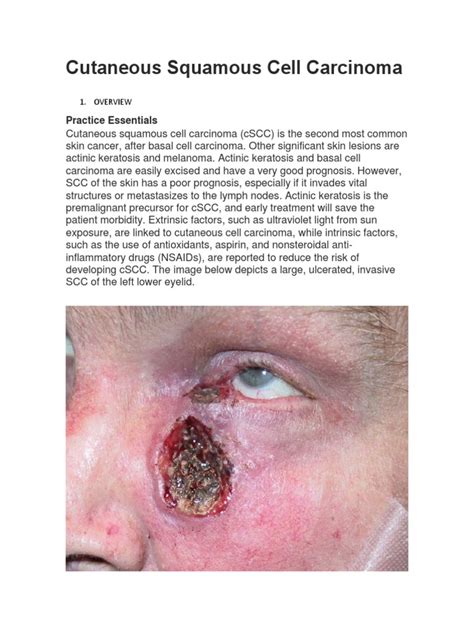 Cutaneous Squamous Cell Carcinoma Skin Cancer Metastasis