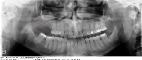Picture Series Sinus Lift Bone Graft For Dental Implants