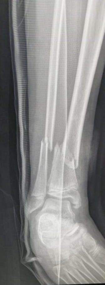 Case Open Tibial Shaft Fracture In An 11m