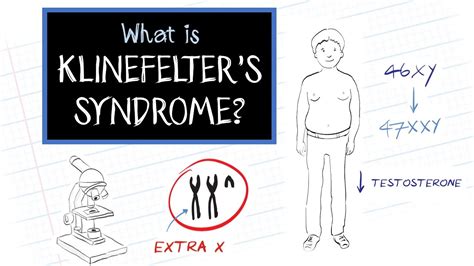 What Is Klinefelter S Syndrome YouTube