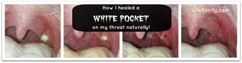 How I Healed A White Pocket On My Throat Naturally Life