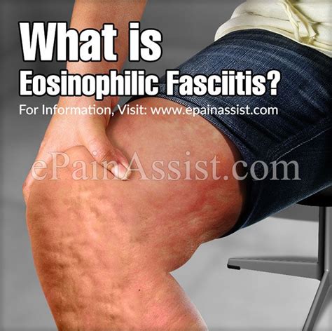 What Is Eosinophilic Fasciitis Autonomic Nervous System Addisons