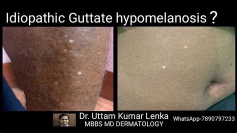 Idiopathic Guttate Hypomelanosis Vs Tinea Versicolor