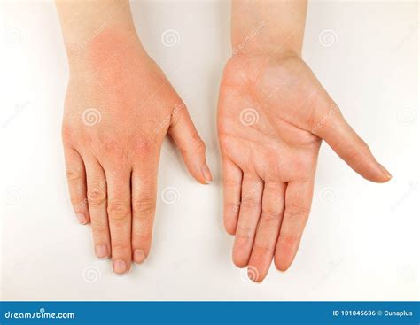 Withered Hand By Cold Weather Stock Photo Image Of Cold Handcare
