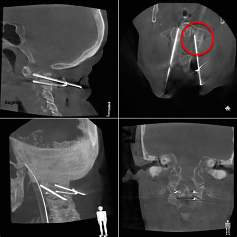 Example For Misplacement Of K Wire In This Case Too Medial In C1 Left