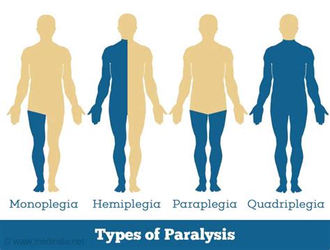 Types Of Paralysis