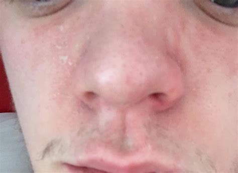 Skin Concerns Flaky Red Rash Around The Nose Area Moisturiser Does