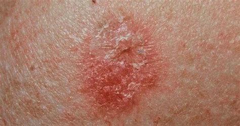 Simple To Recognize Non Melanoma Skin Cancer Symptoms All Cancer
