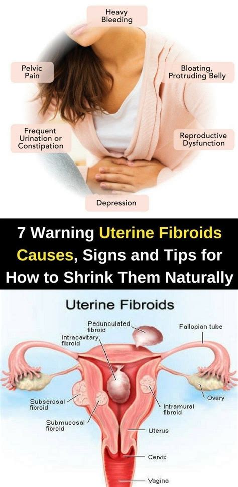 Here Are Warning Uterine Fibroids Causes Signs Tips For How To