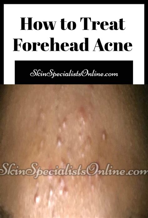 Forehead Acne Causes And Treatment Skin Specialists Online