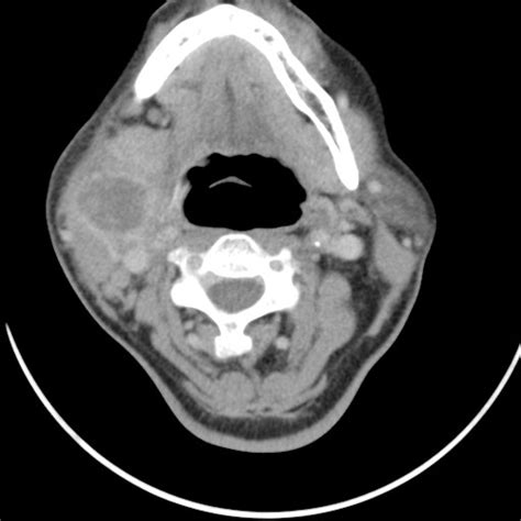 Suppurative Lymphadenitis Radiology Case