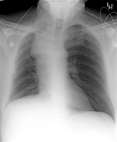 Chest Radiograph Shows A Mass Like Lesion In The Right Paratracheal
