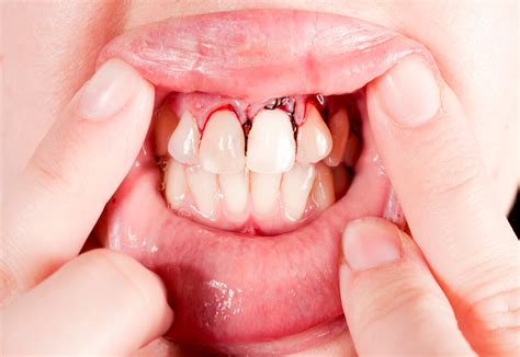 What Happens To An Untreated Tooth Abscess Dr Gibberman