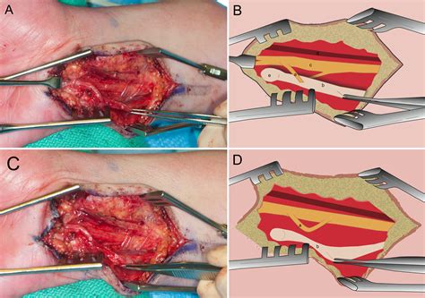 Entrapped Ulnar Nerve By Flexor Carpi Ulnaris Tendon Case Illustration