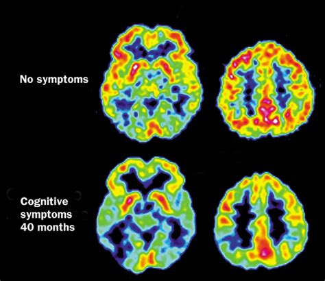 Pet Imaging Of Amyloid In Alzheimers Disease The Lancet Neurology