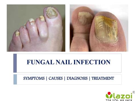 Fungal Nail Infection Causes Symptoms Diagnosis And Treatment Ppt