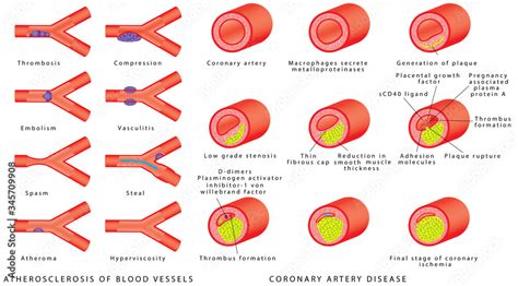 Blood Vessels Arteries Atherosclerosis Of Blood Vessels Healthy And