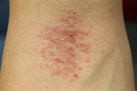 Very Itchy Rash Possible Dh Dermatitis Herpetiformis