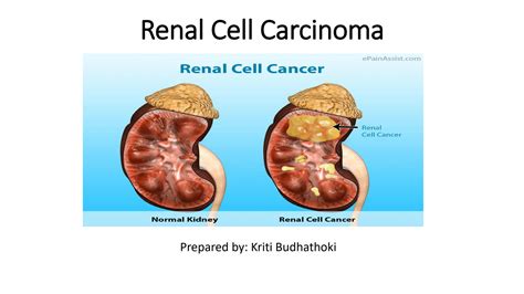 SOLUTION Renal Cell Carcinoma Studypool