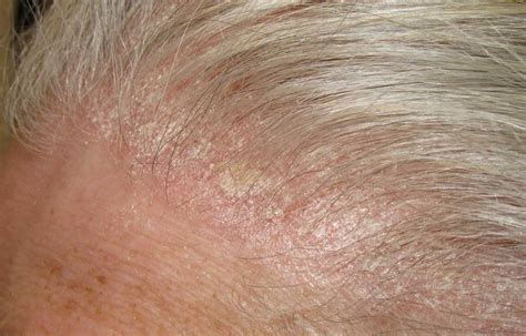 Red Spots On Scalp Pictures Causes And Treatments Porn Sex Picture