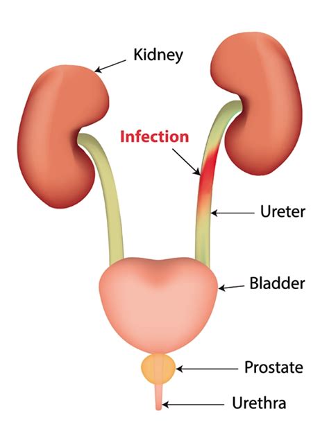 Urinary Tract Infection Complicated Signs And Symptoms Mims Indonesia