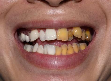 Causes Of Tooth Discoloration And Its Effective Treatment
