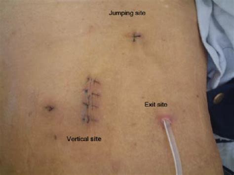 Tenckhoff Peritoneal Dialysis Catheter